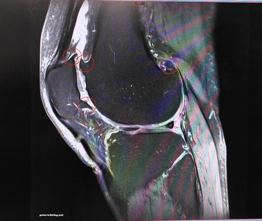 On my knees - this is the MRI of might right knee before the operation