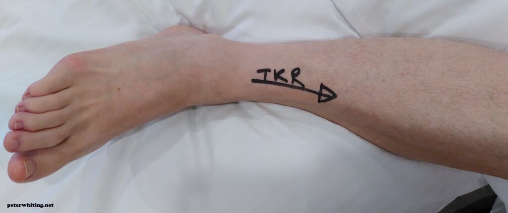 On my knees - TKR marked on the leg to be operated upon
