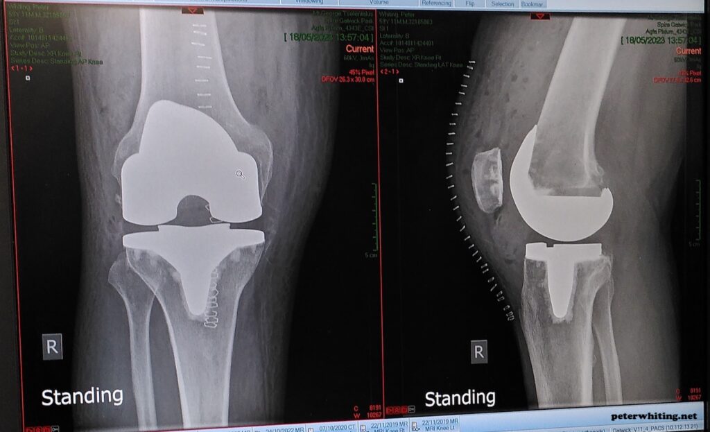 x-ray of my knee post-operation