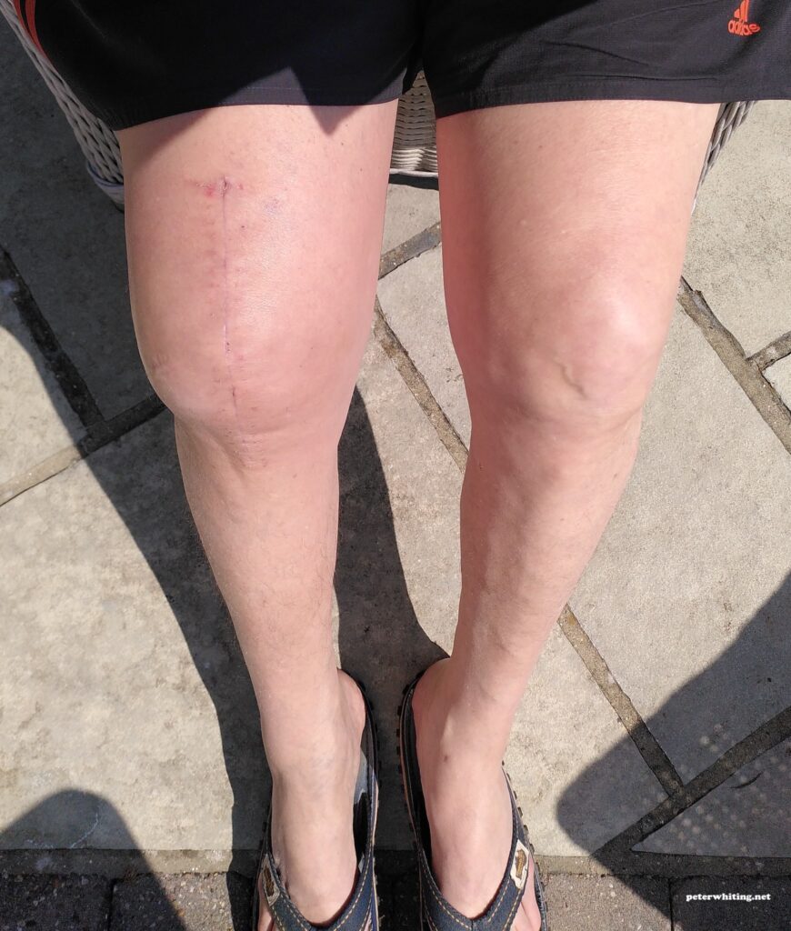 On my knees - sitting in the sun a few weeks after the total knee replacement